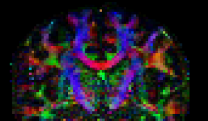 colour FA coronal
